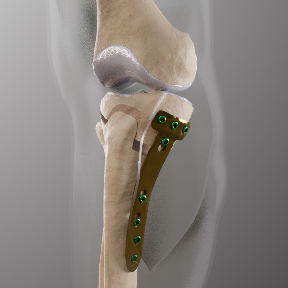 Tibial Osteotomy
